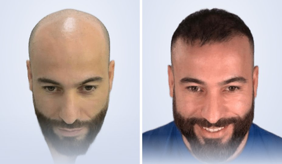 Hair transplant before and after, 5 months later