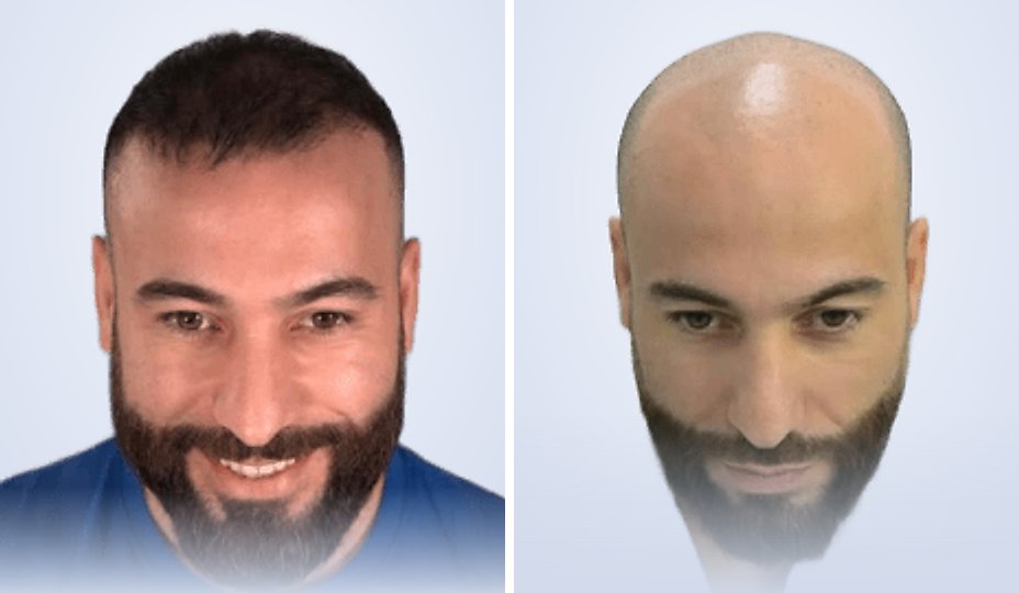 زراعة الشعر قبل وبعد، بعد 5 أشهر