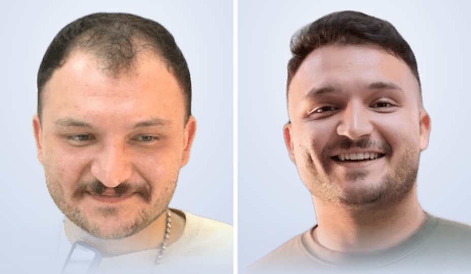 Hair transplant before and after, 6 months later
