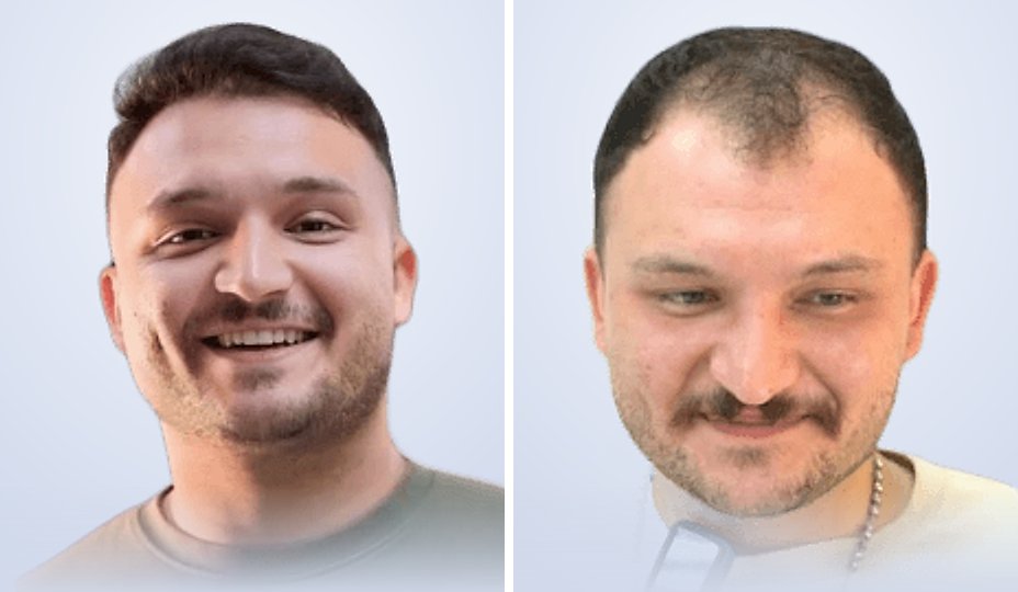 زراعة الشعر قبل وبعد، بعد 6 أشهر
