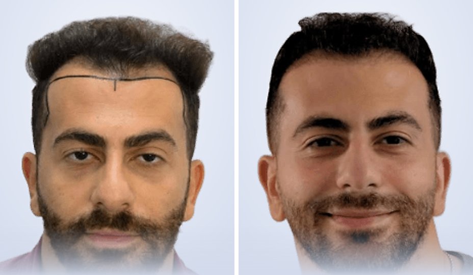 Hair transplant before and after, 6 months later
