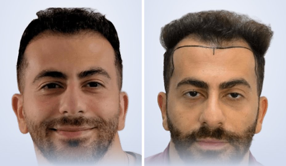 زراعة الشعر قبل وبعد، بعد 6 أشهر