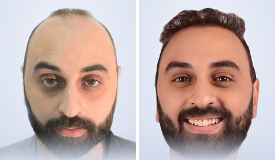 Hair transplant before and after, 6 months later