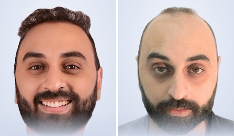 زراعة الشعر قبل وبعد، بعد 6 أشهر