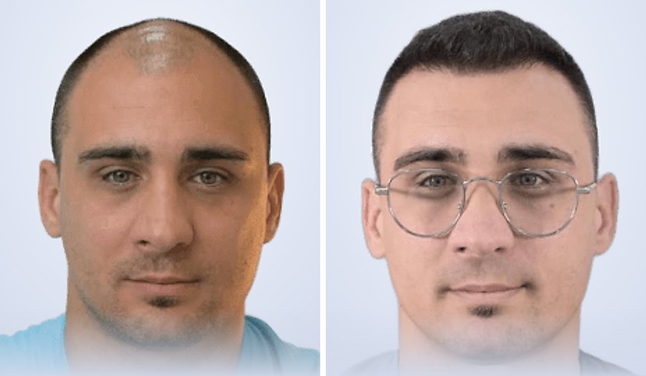 Hair transplant before and after, 4 months later
