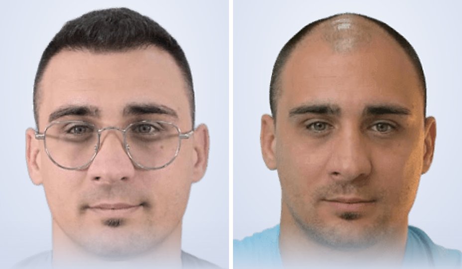 زراعة الشعر قبل وبعد، بعد 4 أشهر