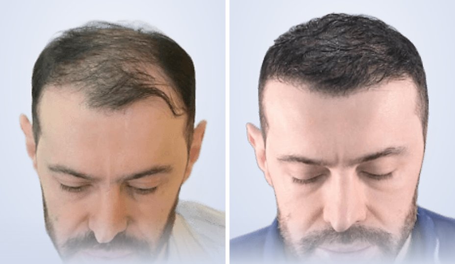 Hair transplant before and after, 6 months later