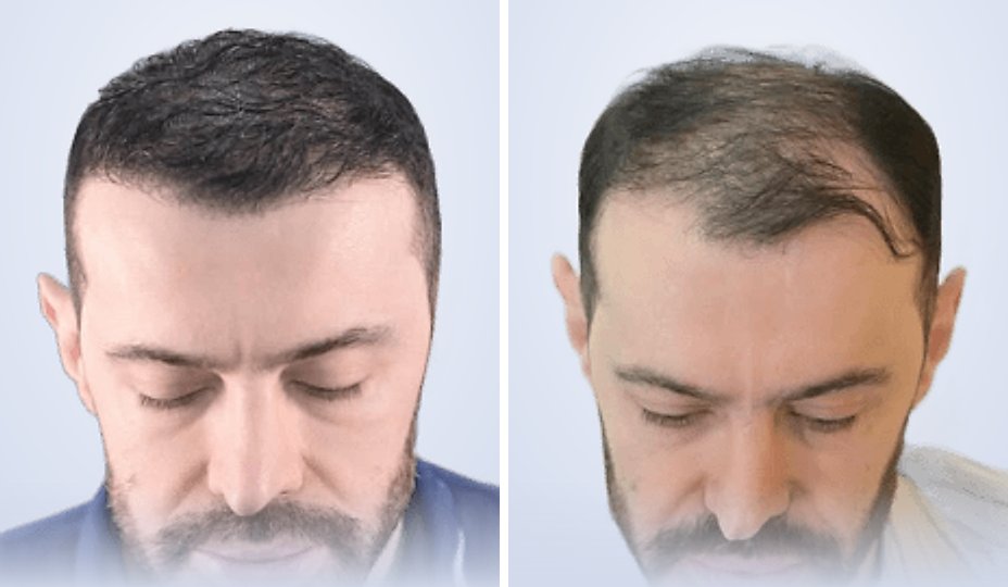 زراعة الشعر قبل وبعد، بعد 6 أشهر